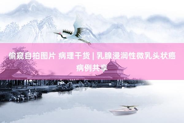 偷窥自拍图片 病理干货 | 乳腺浸润性微乳头状癌病例共享